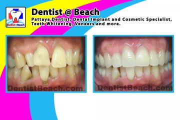 Smile Makeover & Cosmetic works