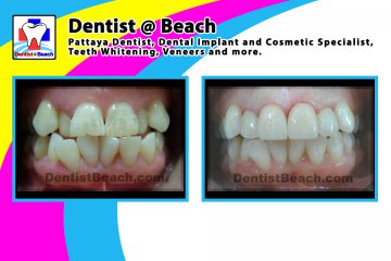 Only few upper teeth makeover